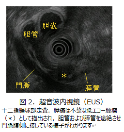 図2．超音波内視鏡（EUS）