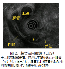 図2.超音波内視鏡(EUS)