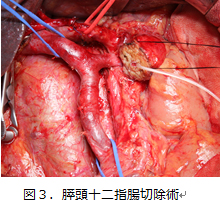 図3 膵頭十二指腸切除術