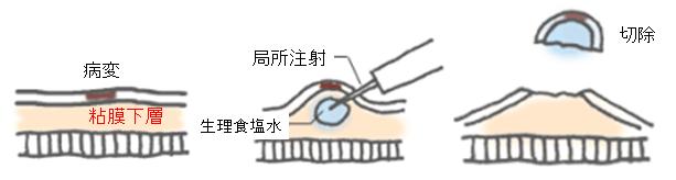 早期食道癌・早期胃癌の内視鏡的治療