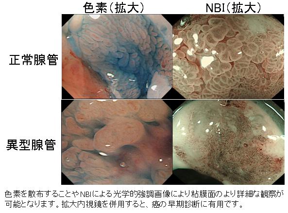 正常腺管、異型腺管