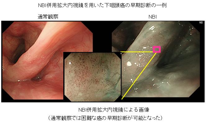 NBI併用拡大内視鏡による画像