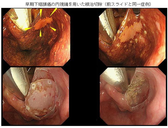 早期下咽頭癌を内視鏡を用いた根治切除