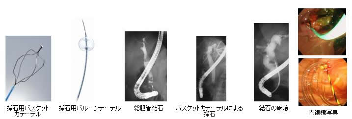 採石用バスケットカテーテル、採石用バルーンテーテル、総胆管血栓、バスケットカテーテルによる採石、結石の破壊、内視鏡写真