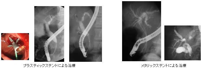 プラスティックステントによる治療、メタリックステントによる治療