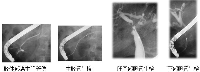 悪性膵・胆管病変の診断