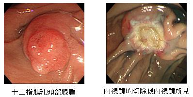 十二指腸乳頭部腺腫、内視鏡的切除後内視鏡所見