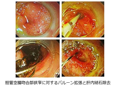 術後再建腸管に対する膵・胆道内視鏡検査