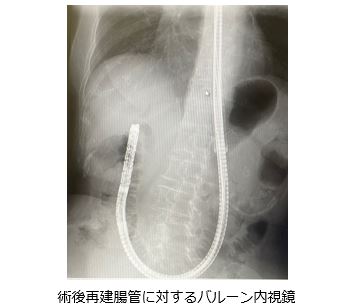 術後再建腸管に対する膵・胆道内視鏡検査