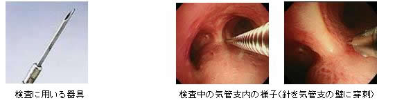 検査に用いる器具/検査中のレントゲン/検査中の気管支内の様子
