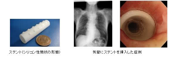 ステント（シリコン性筒状の形態）・気管にステントを挿入した症例