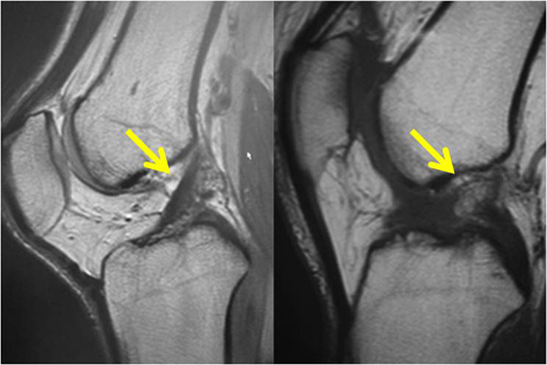 膝関節前十字靱帯（ACL）