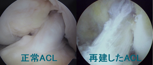 左:正常 右:再建したACL