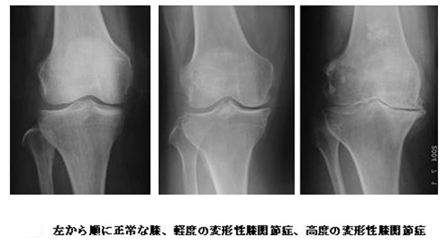 左から順に正常な膝、軽度の変形性膝関節症、高度の変形性膝関節症