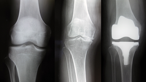 左：正常　中央：変形性膝関節症　右：人工膝関節置換術