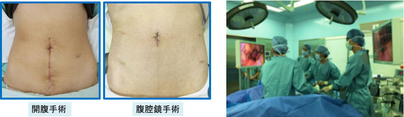 開腹手術と腹腔鏡手術の術後の比較写真