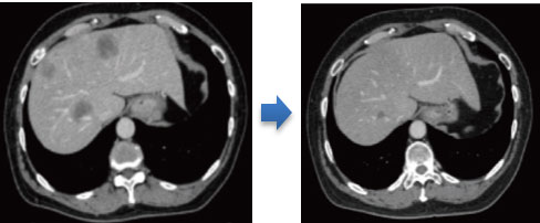 腫瘍のレントゲン写真