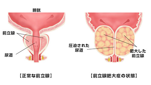 正常な前立腺と前立腺肥大の状態