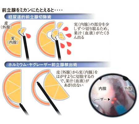 前立腺をみかんにたとえた時のイメージ