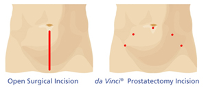 左：開腹手術の切開口、右：ダ・ヴィンチ手術の切開口