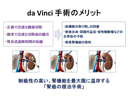 da Vinci手術のメリット