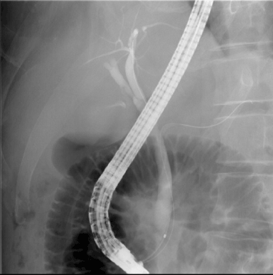 内視鏡的逆行性胆管膵管造影の写真