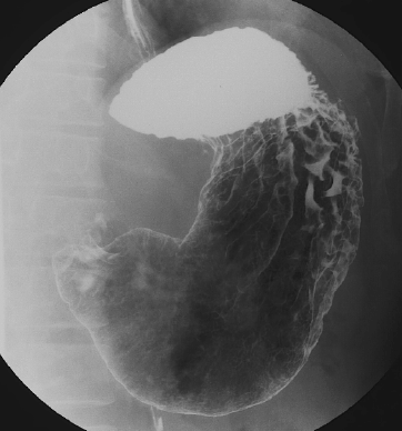 胃の透視検査の写真
