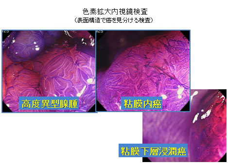 色素拡大内視鏡検査