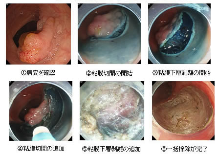 切開剥離術