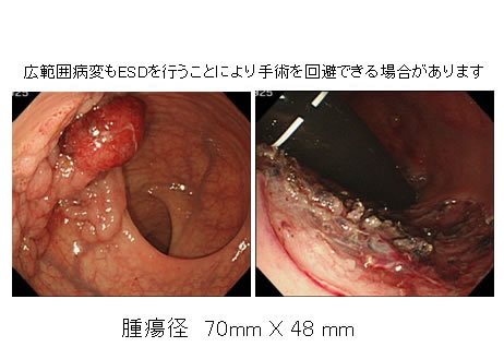 広範囲病変もESDを行うことにより手術を回避できる場合があります