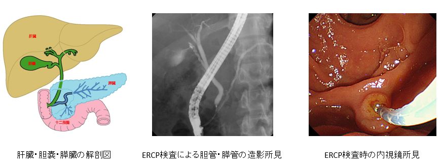 内視鏡的逆行性胆管膵管造影検査の様子