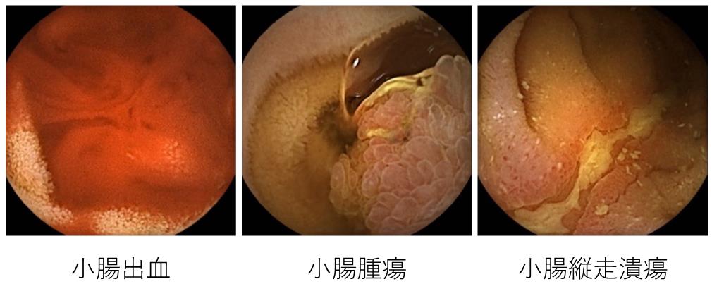 超音波内視鏡下穿刺吸引法EUS-FNAの様子