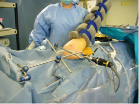 関節鏡と小さい手術道具を挿入して腱板の処置を行います. 