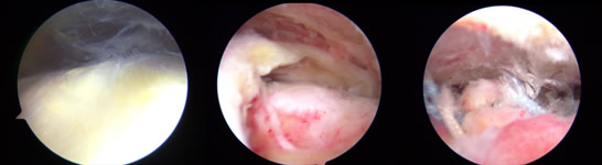 (左)正常の肩関節腱板所見 (中央)腱板断裂の関節鏡所見。腱と上腕骨の間に大きい穴が開いている。(右) 腱板断裂修復後の状態