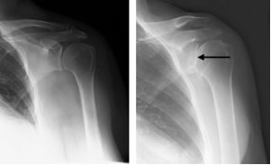 左は正常の肩のレントゲン。右は変形性肩関節症のレントゲン。右の肩関節は隙間がほぼ無くなっています。