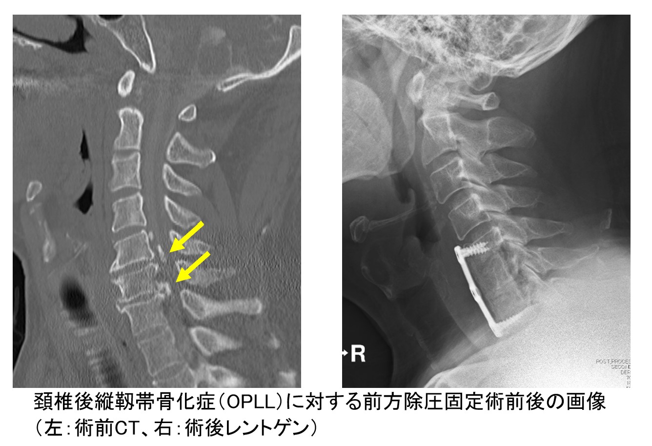 後縦靱帯骨化症(OPLL)・黄色靭帯骨化症について