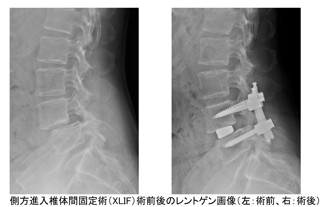 腰部脊柱管狭窄症・腰椎変性すべり症について