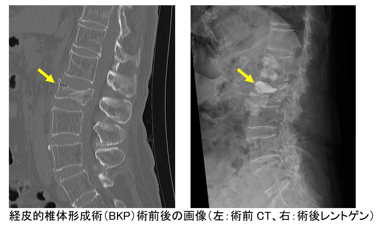 骨粗鬆症性椎体骨折・脊椎圧迫骨折・脊椎破裂骨折について