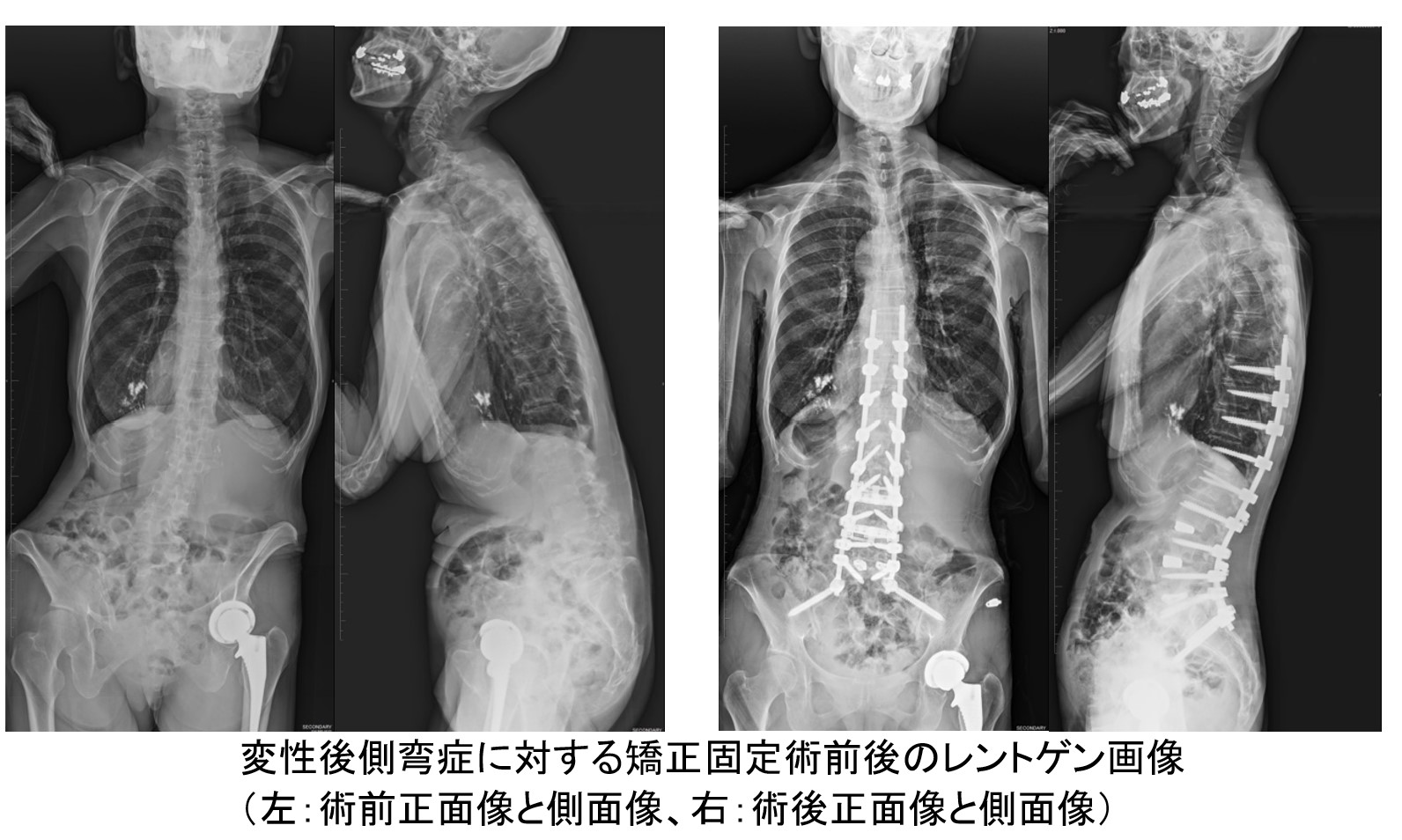 腰椎変性側弯症・後側弯症について