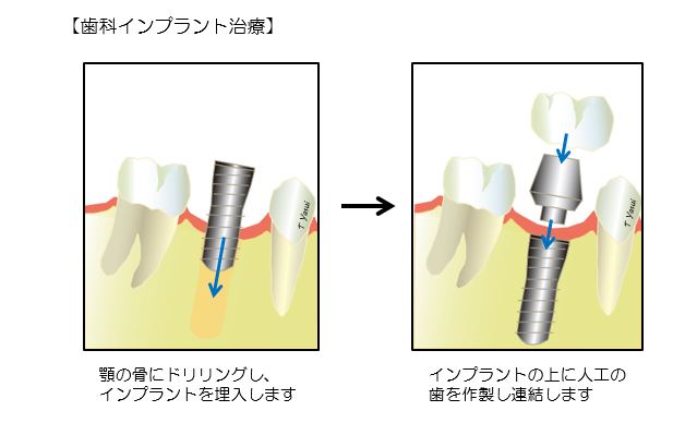 歯科・口腔外科の歯科インプラント治療の画像