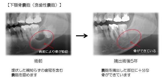 歯科・口腔外科の嚢胞の画像