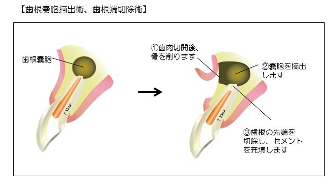 歯科・口腔外科の歯根端切除術の画像