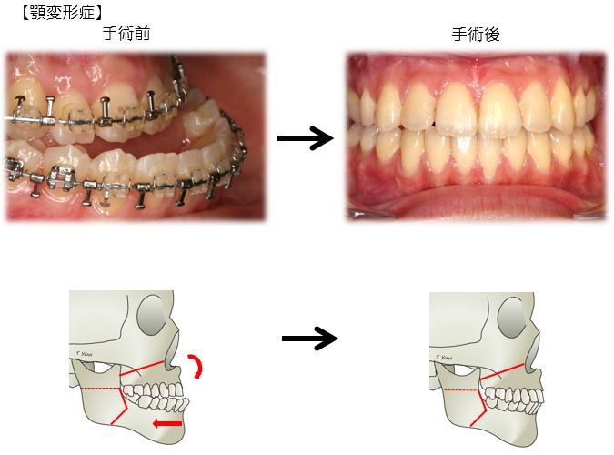 歯科・口腔外科の顎変形症・うけ口・出っ歯・ぐちゃぐちゃ歯列の画像